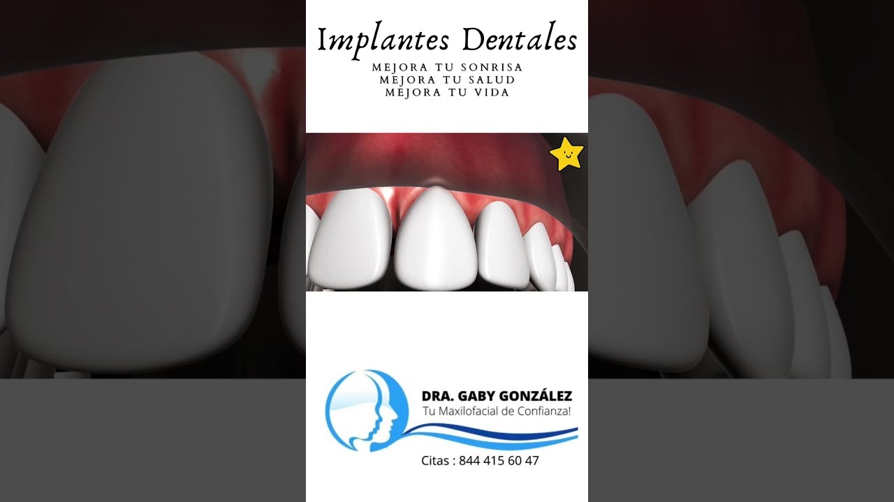 Dra. Gaby Gonz&aacute;lez Maxilofacial Saltillo. Implantes Dentales