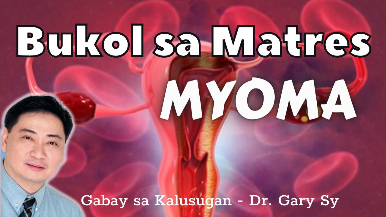 Myoma: Uterine Fibroids - Dr. Gary Sy