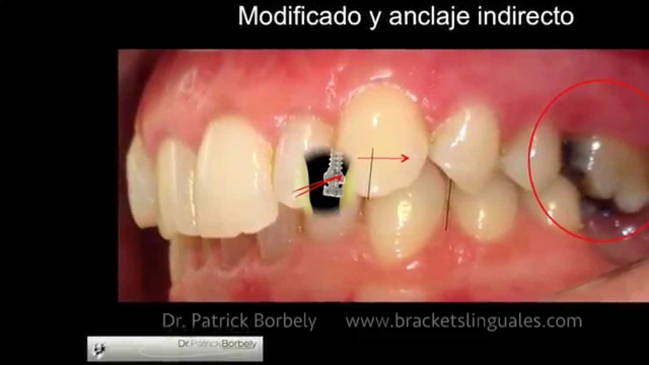 BIOMECÁNICA CON MINI IMPLANTES # 4 DISTALIZACIÓN CON SLIDING