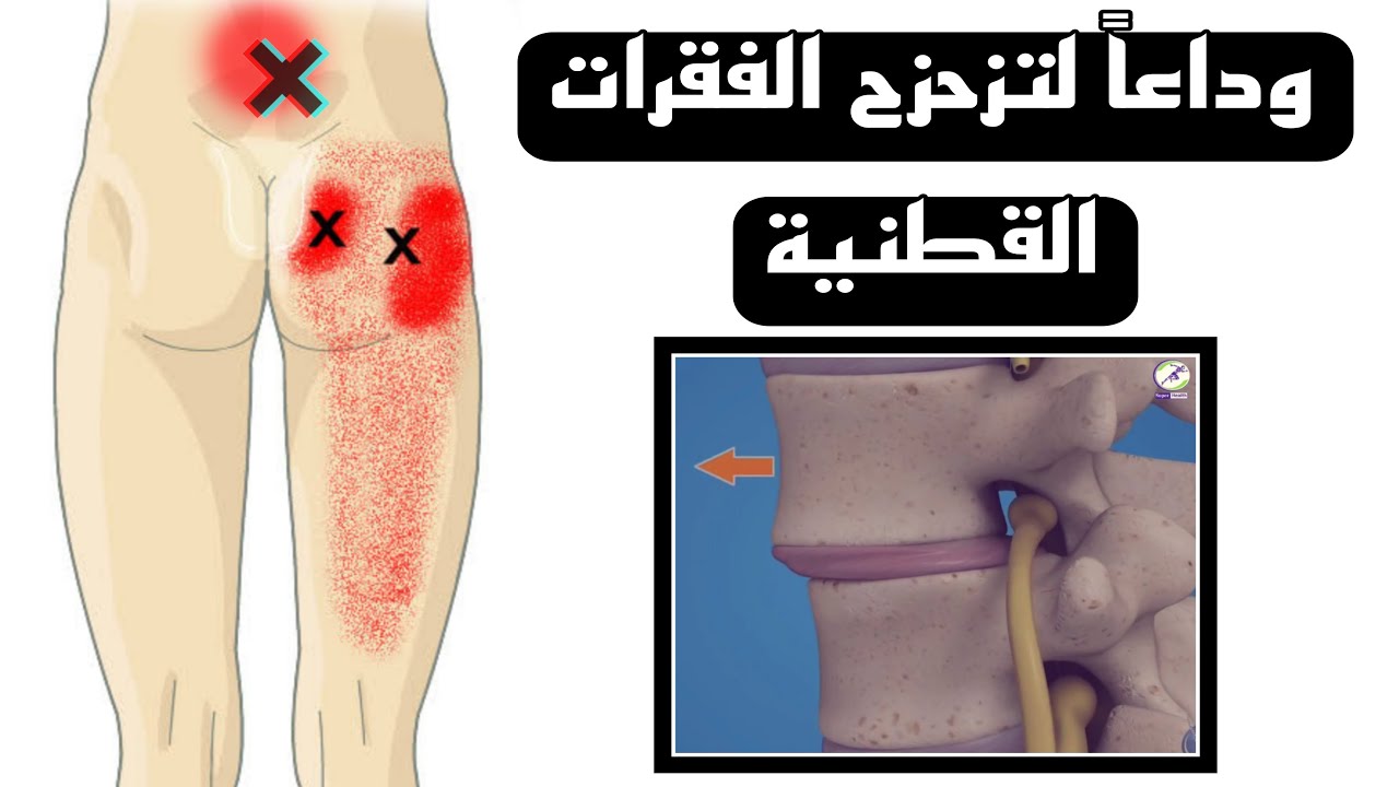 علاج تزحزح الفقرات القطنية بدون جراحه |تزحزح الفقره الرابعه والخامسة