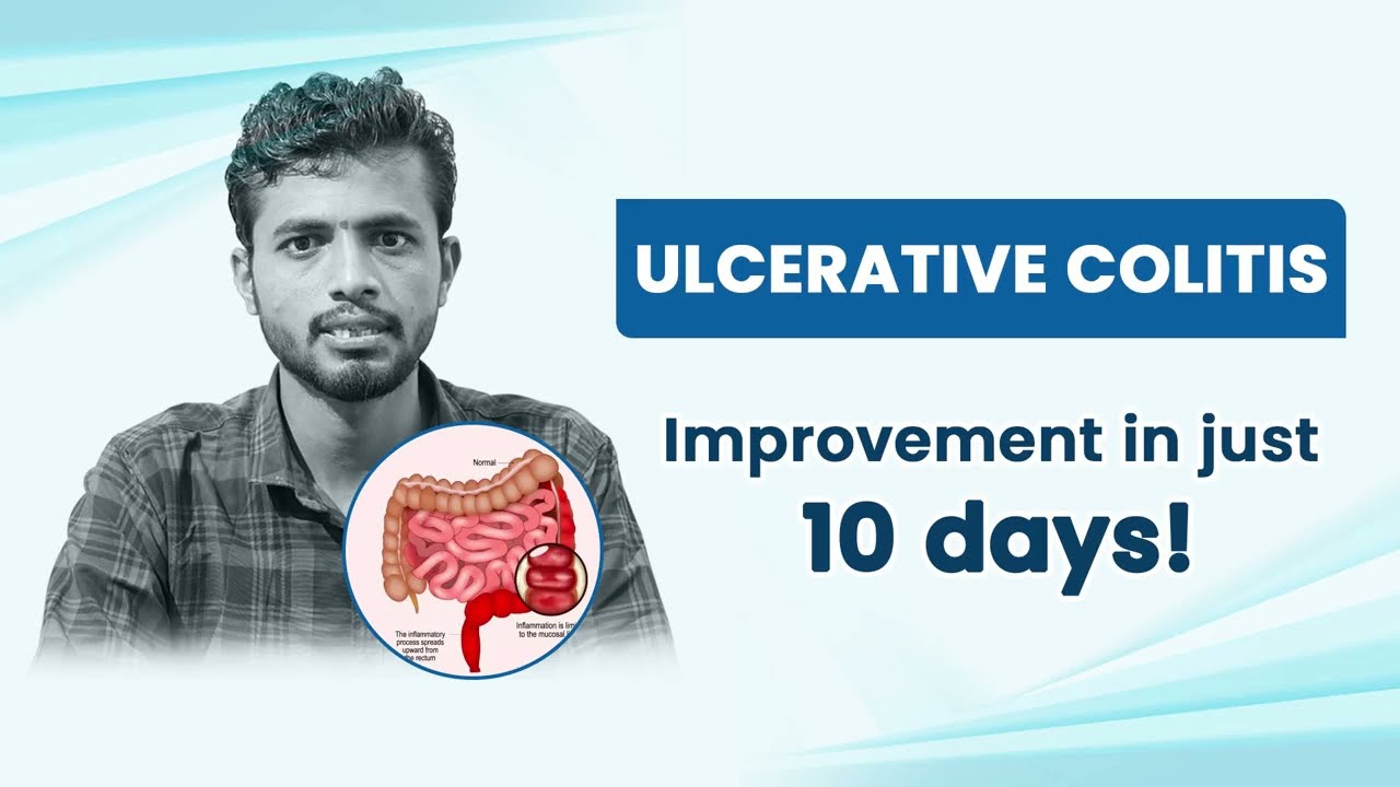 Ulcerative Colitis Relieved in Just 10 Days | A Success Story of Modern Homeopathy Treatment