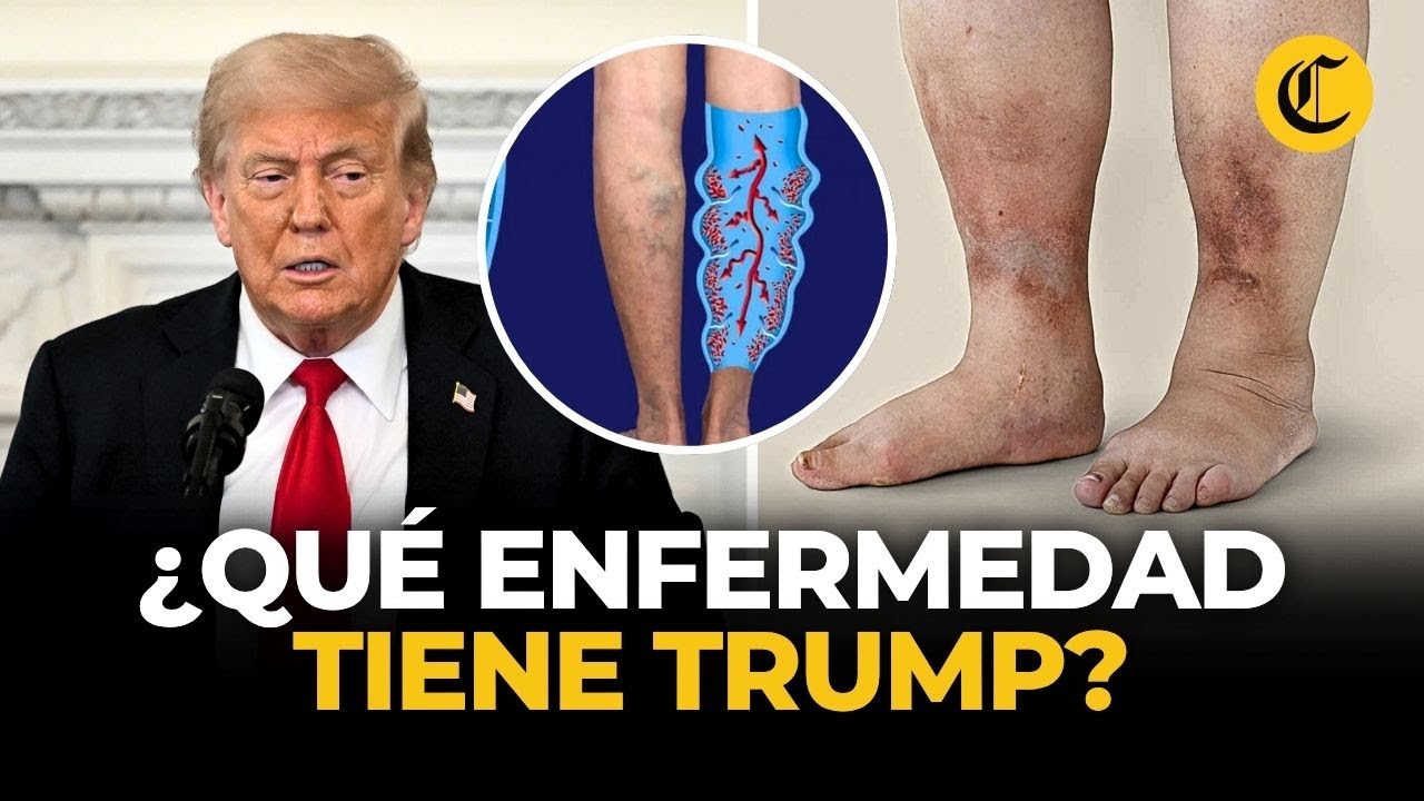 Insuficiencia venosa crónica: la enfermedad que le diagnosticaron a Trump | El Comercio