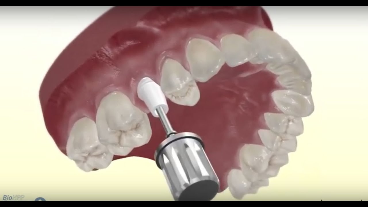 Video procedura implant dentar - Inserare implant + coroana dentara intr-o zi!