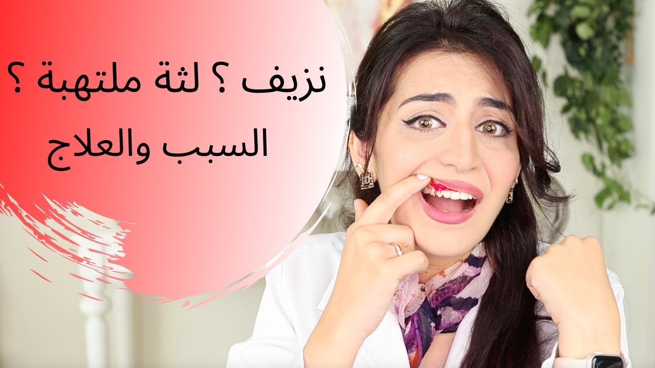 نزيف اللثة الأسباب و العلاج