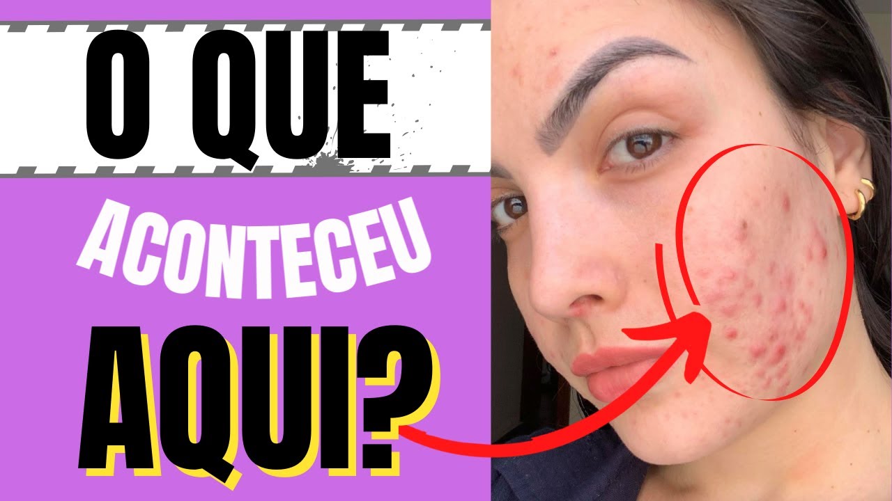ESPIRONOLACTONA PARA ACNE [espinhas] HORMONAL TUDO EXPLICADO