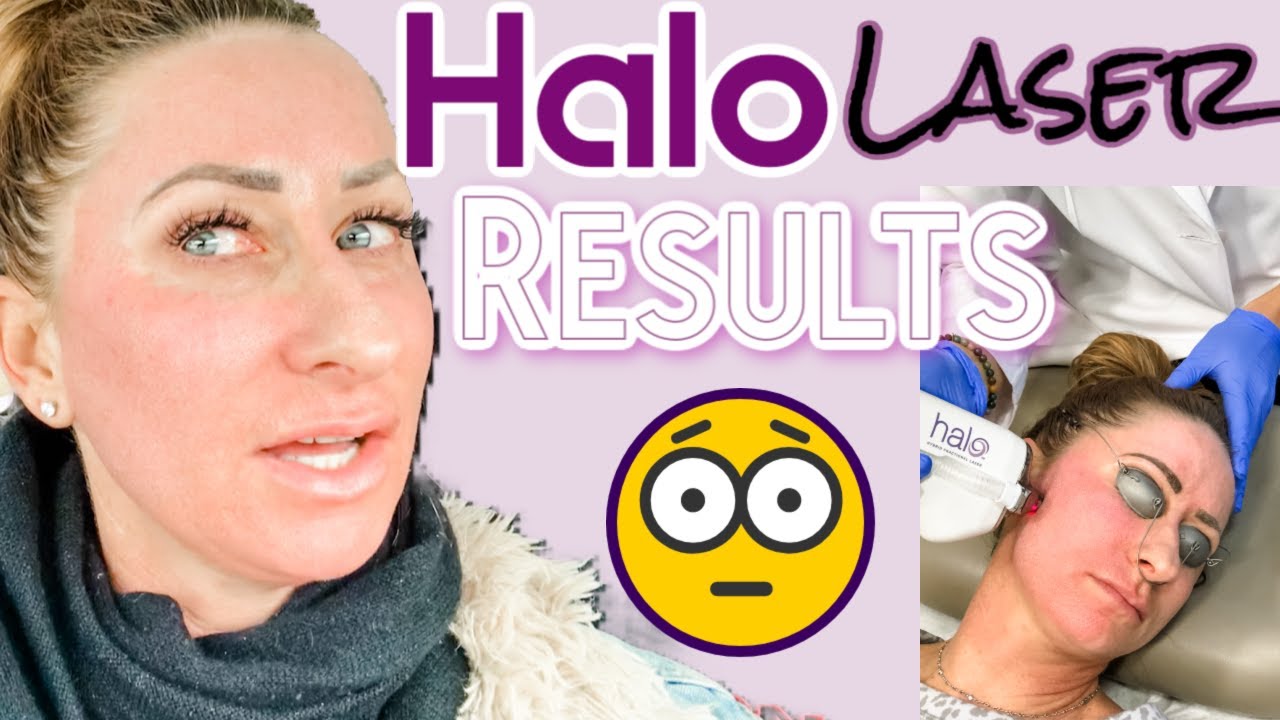 Halo Laser Recovery, Before & After Final Thoughts Over 40 (Combination Skin)