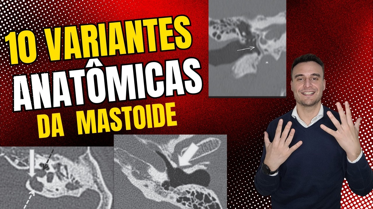 10 variantes anatômicas dos ossos temporais na tomografia que o radiologista deve conhecer