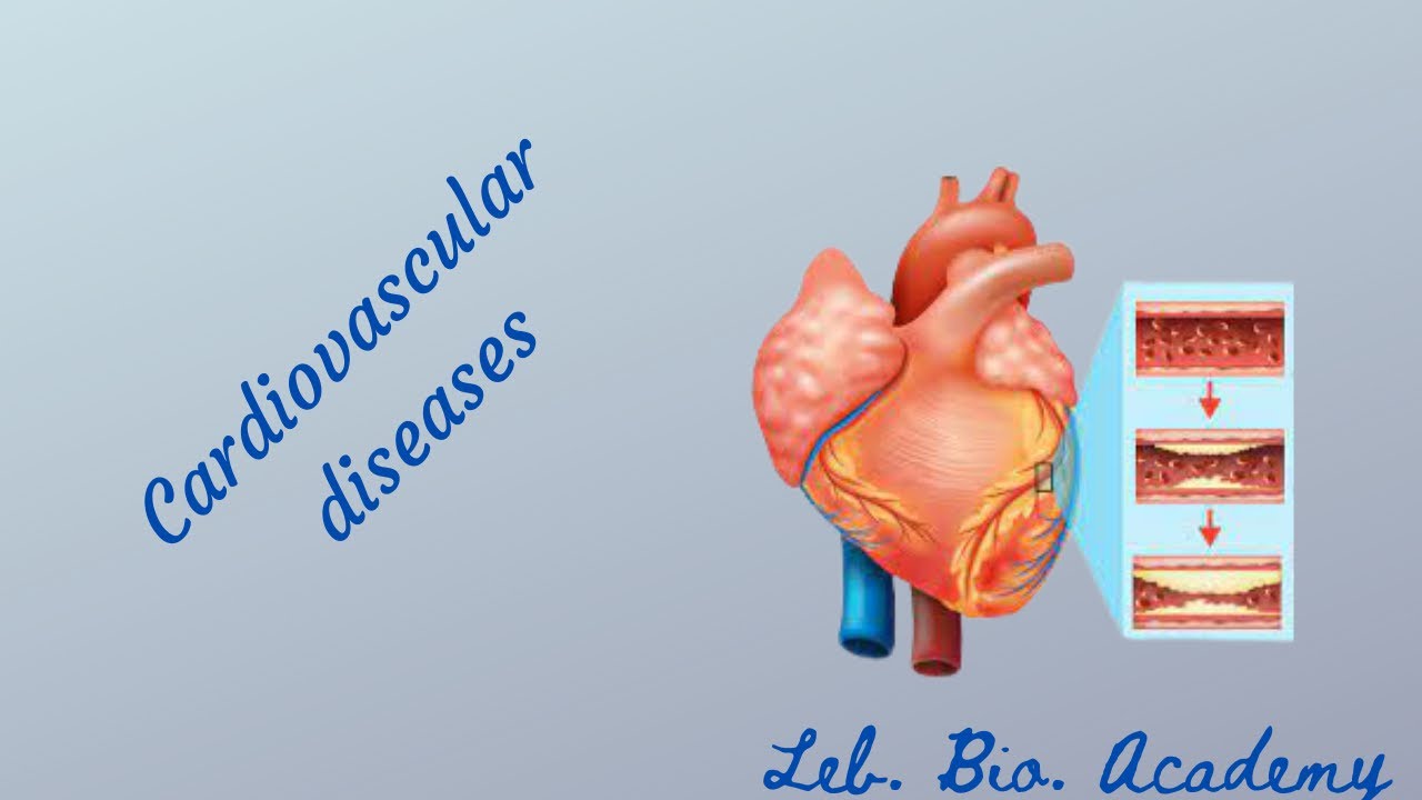 Cardiovascular accidents