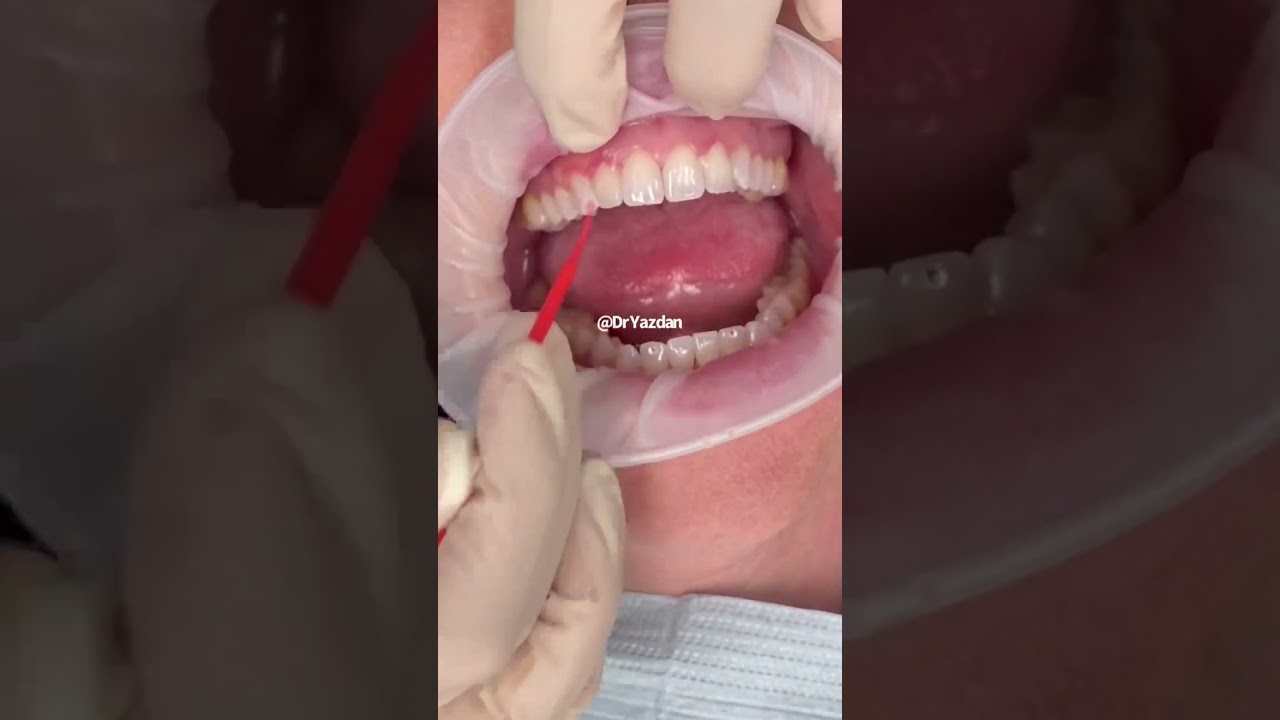 Peg laterals | porcelain veneers procedure | porcelain veneers before and after | tooth gem removal