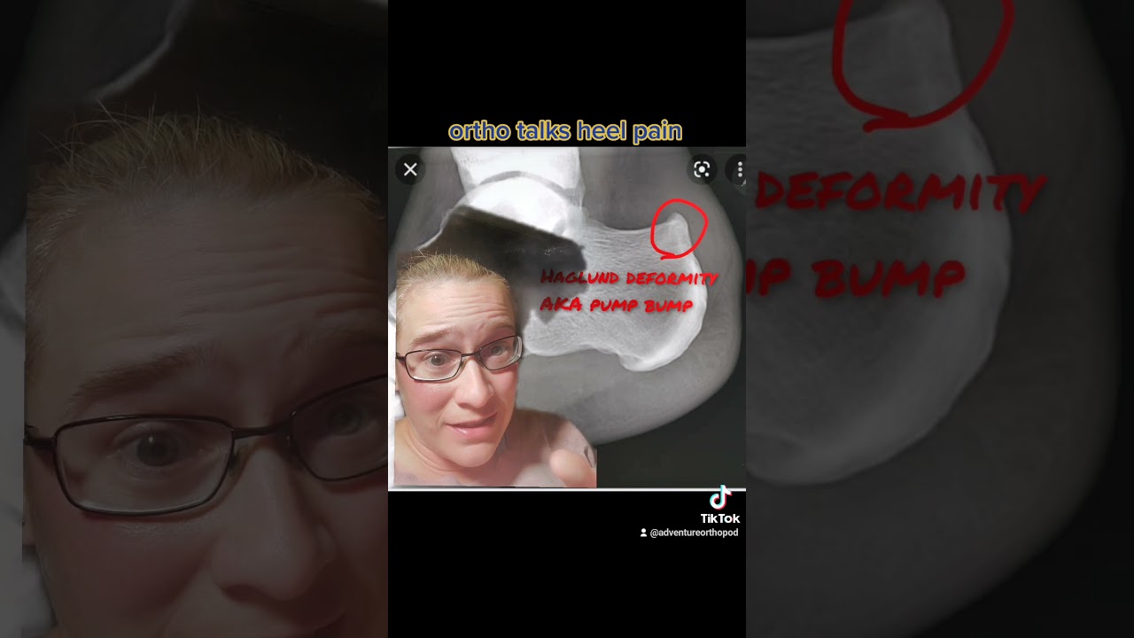 Ortho talks Haglund deformity and Achilles pain