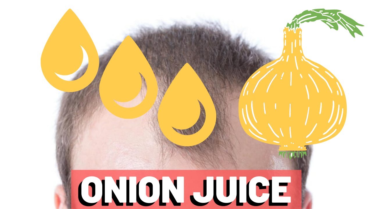 Onion Juice For Hair Loss - Can It Work?