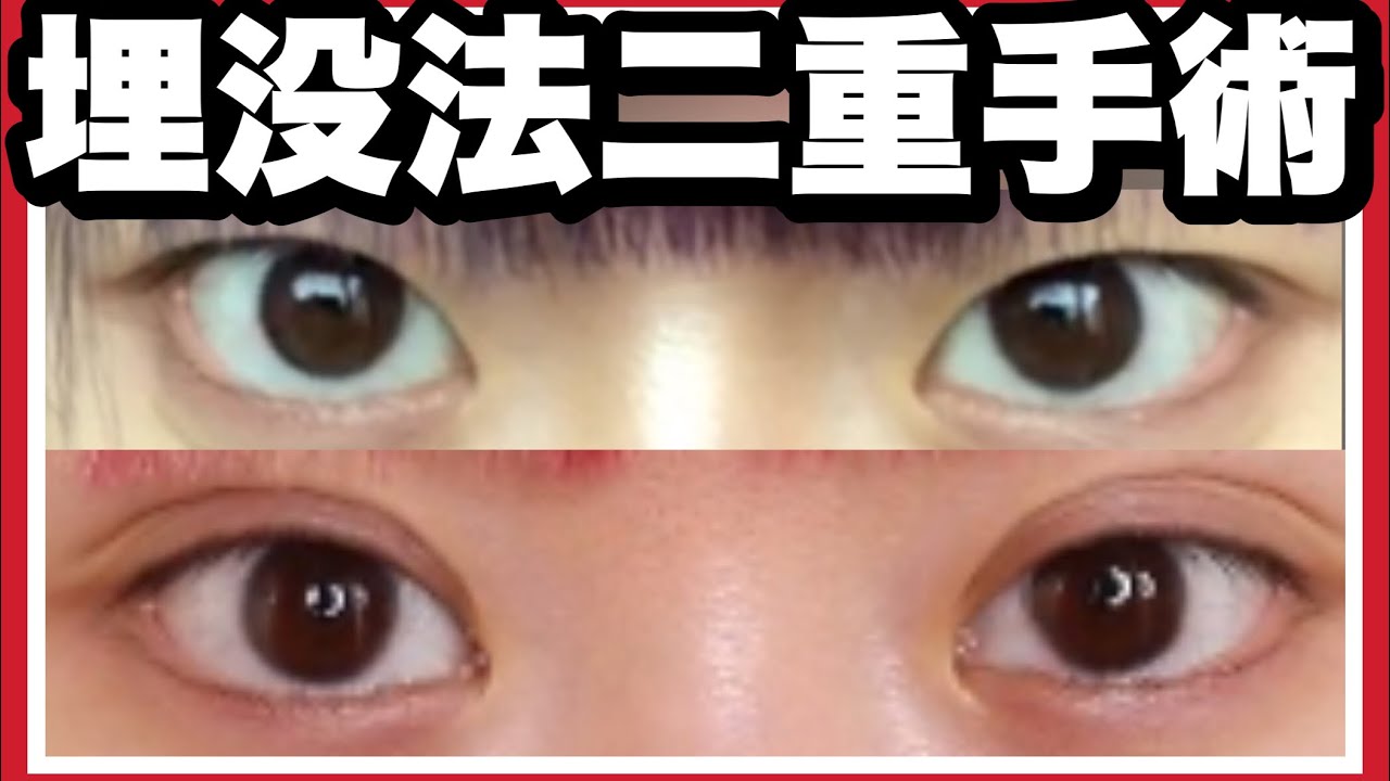 【埋没法】さよなら逆さまつ毛。遂に二重になりました。【二重手術】