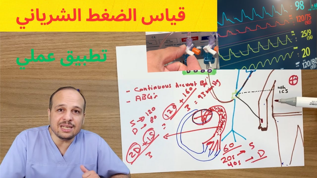 ضغط الدم الشرياني عبر الخط الشرياني (Arterial Line) | شرح نظري وعملي