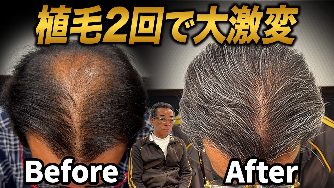諦めなければ人生は変わる｜植毛6ヶ月経過のリアル【2回目】