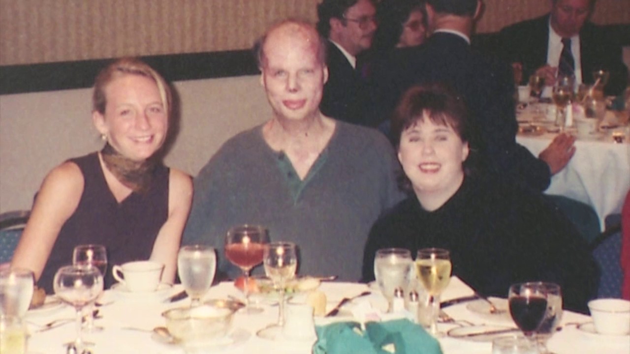 1998 bus fire leads burn nurse to career as burn surgeon