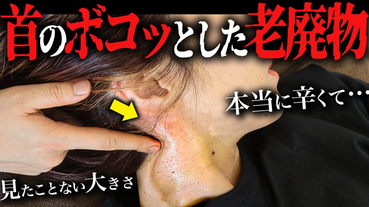 【超巨大】老廃物でパンパンに膨れ上がった首に激痛整体をしたら…驚きの変化に思わず…