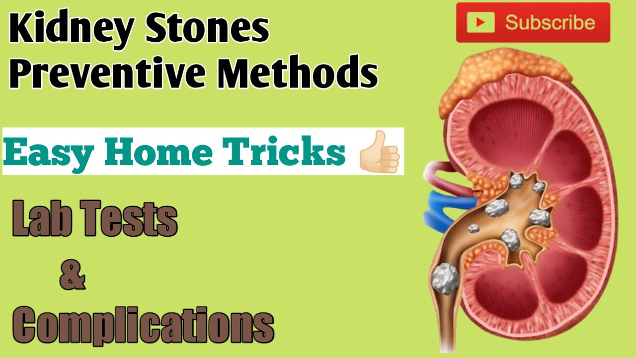 Kidney Stones - its preventive measures, Easy home management measures, Lab tests & Complications