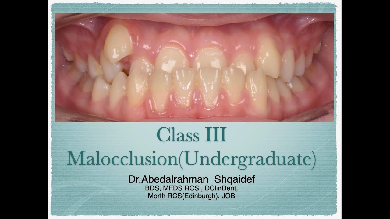 Class III malocclusion (Undergraduate)