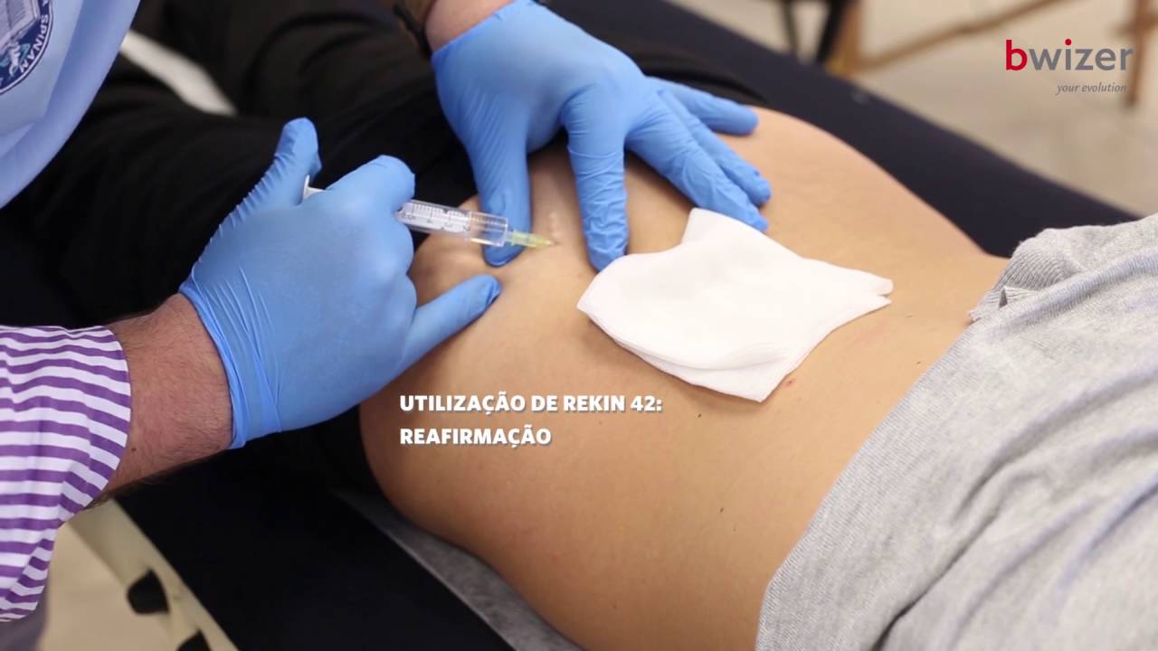 Mesoterapia homeopática no tratamento das estrias | Bwizer