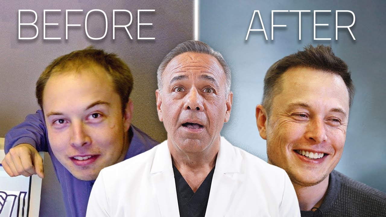 Elon Musk's Hair Transplant | Surgeon Reacts