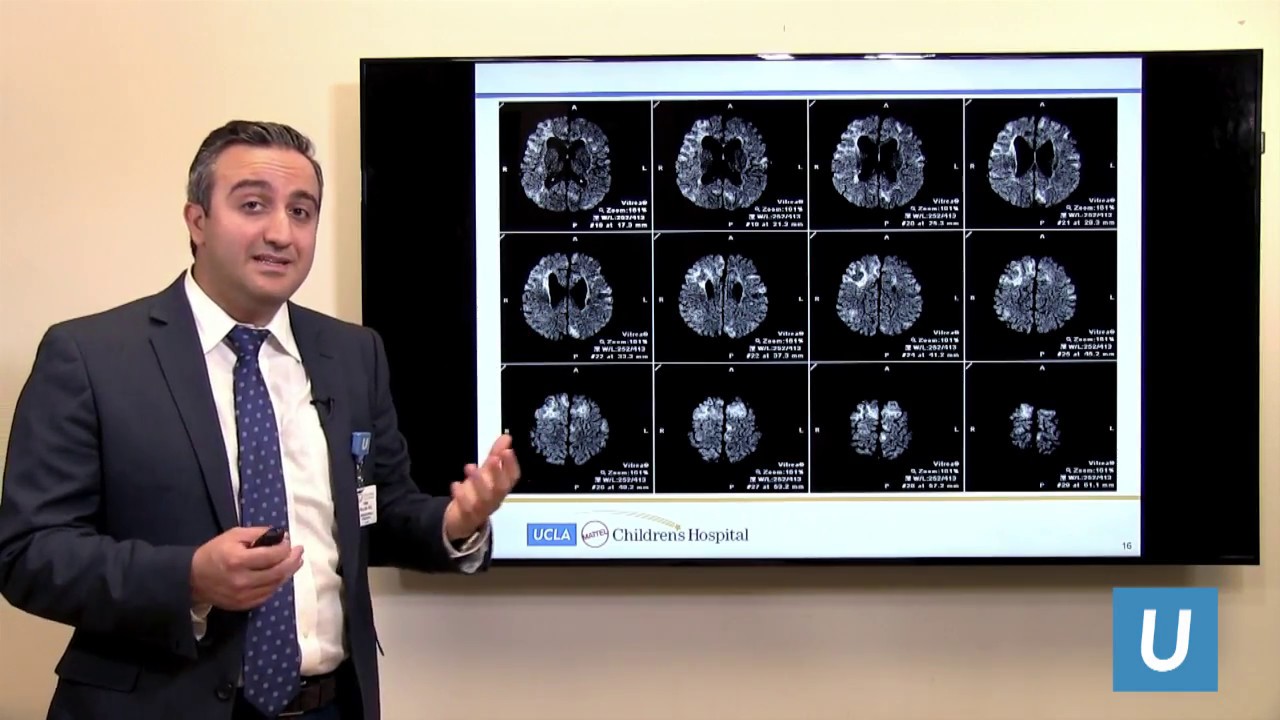Surgical Treatment of Epilepsy in Children with Tuberous Sclerosis Complex | UCLAMDChat