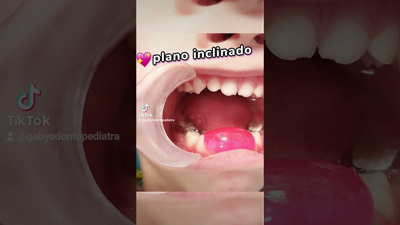 Mordida cruzada anterior en ni&ntilde;os