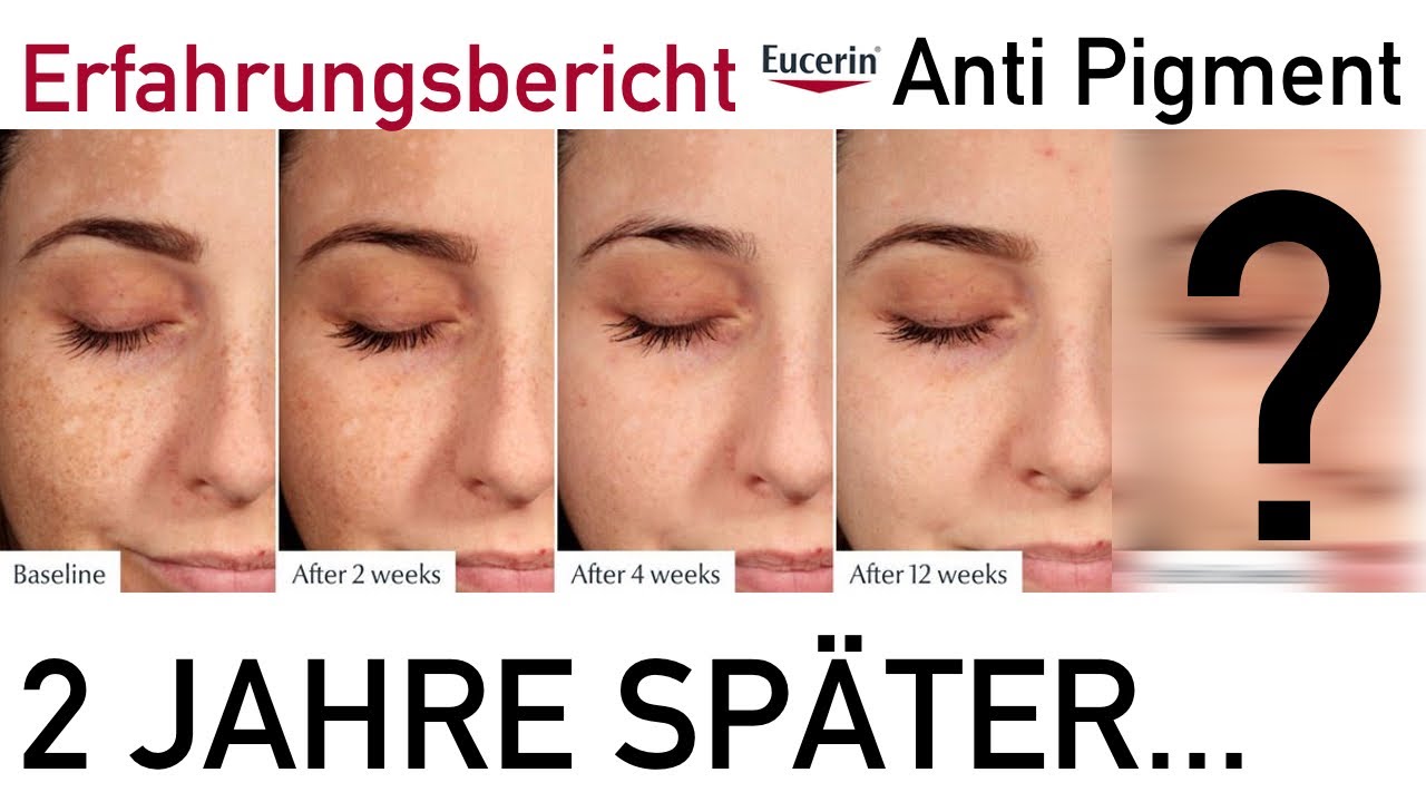 Pigmentflecken Update nach 2 Jahren Eucerin #AntiPigment | + Emotionale Story Haut blutig wegge&auml;tzt