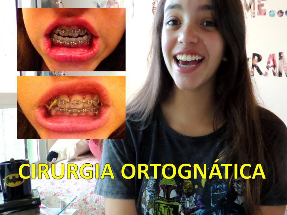 Cirurgia Ortognática : Manual de Sobrevivência (Débora Aladim)
