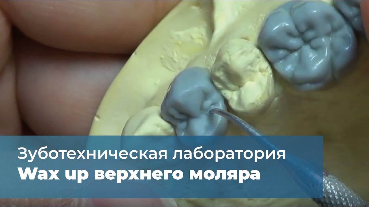 Wax up верхнего моляра
