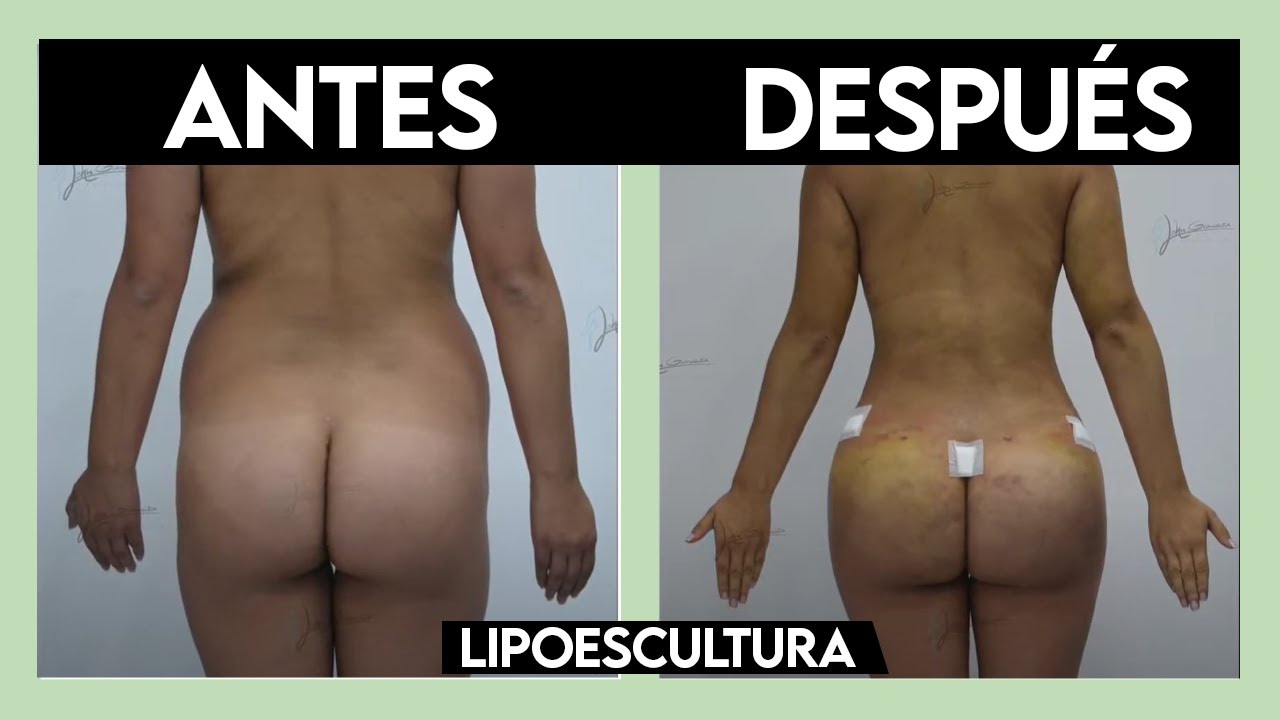 RESULTADOS ANTES y DESPUÉS 🔥 ¡EL 5 ES SORPRENDENTE! 🔥 Lipoescultura con J Plasma ► Dr John Garcia