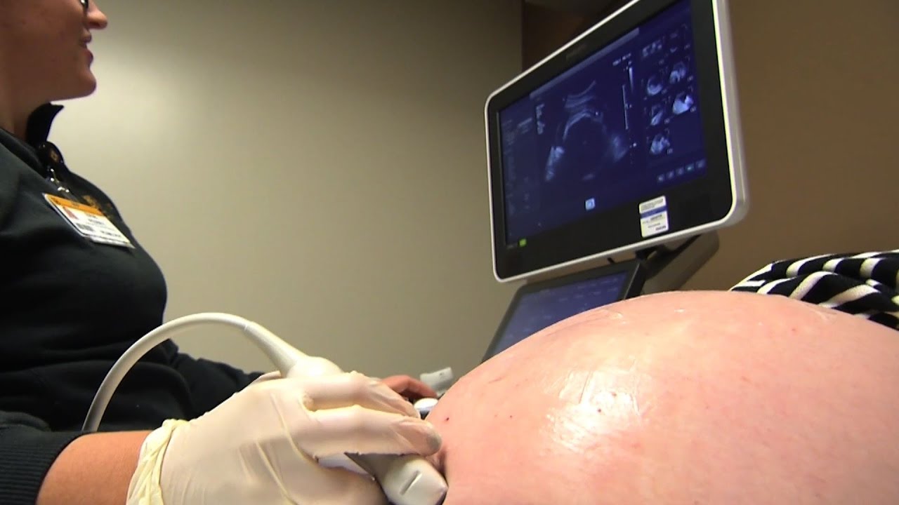 Stress During Pregnancy Observed in Mothers of Children with Autism