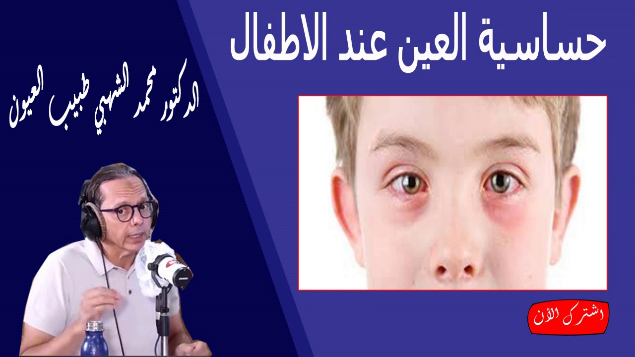 ماهي اسباب حساسية العين عند الاطفال الدكتور محمد الشهبي طبيب العيون