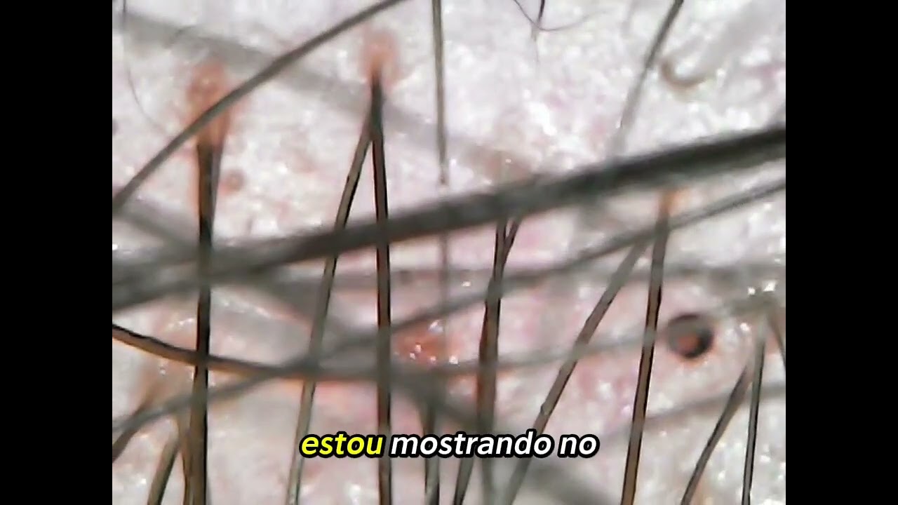Olhar Especial ao Couro Cabeludo Que Pode Mudar Seu Tratamento