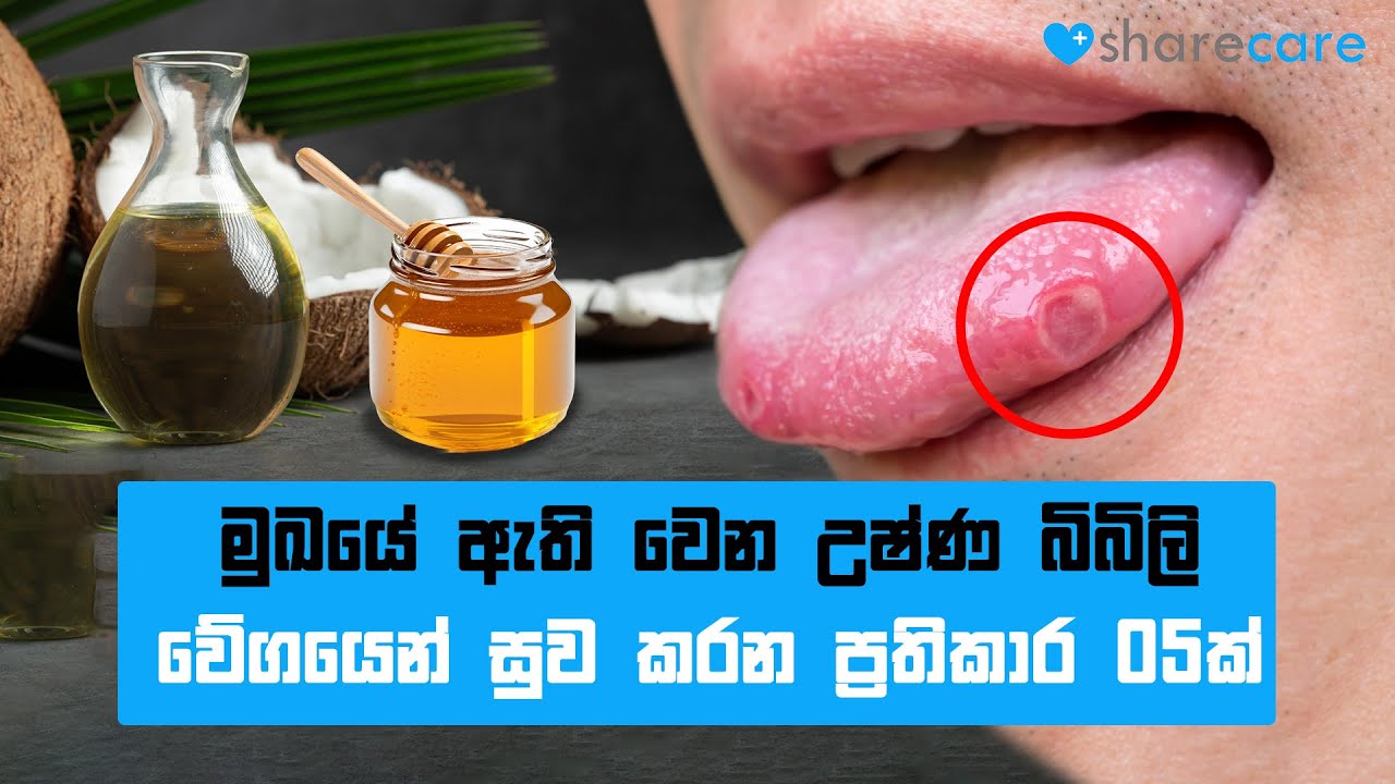 මුඛයේ ඇති වෙන උෂ්ණ බිබිලි වේගයෙන් සුව කරන ප්&zwj;රතිකාර&nbsp;05ක්