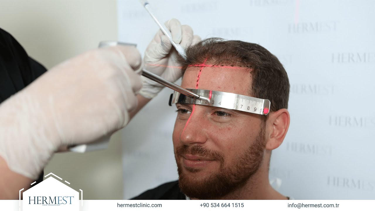Hermest Hair Transplant Turkey