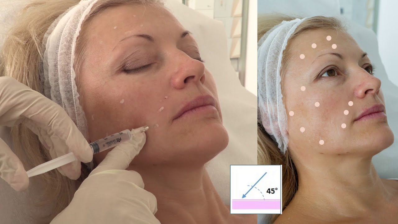 Sunekos 200  - biorigenerante della matrice extra cellulare - Tecniche iniettive