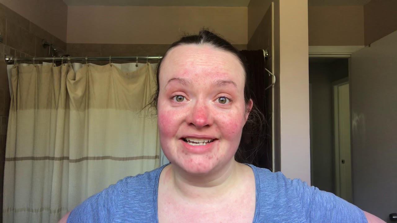 My varicose vein story
