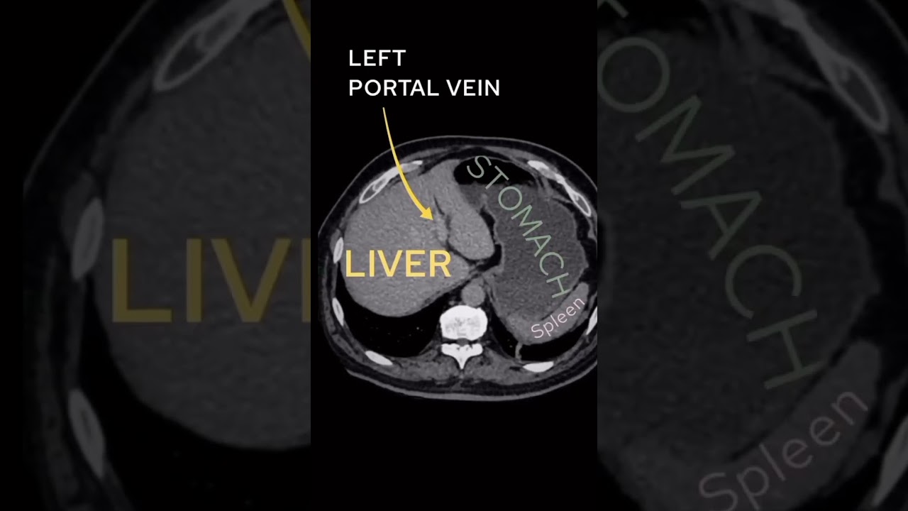 CT ABDOMEN