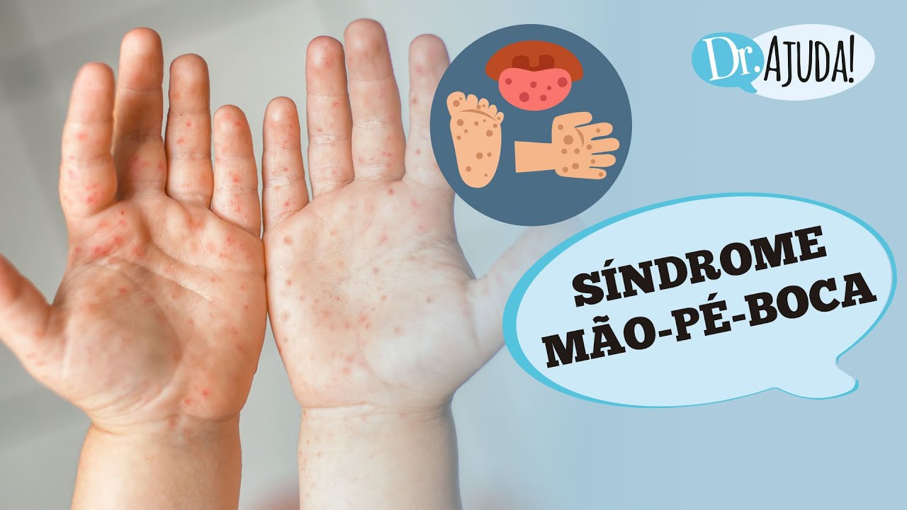 SÍNDROME MÃO – PÉ – BOCA: O QUE É, SINTOMAS, DIAGNÓSTICO E TRATAMENTO