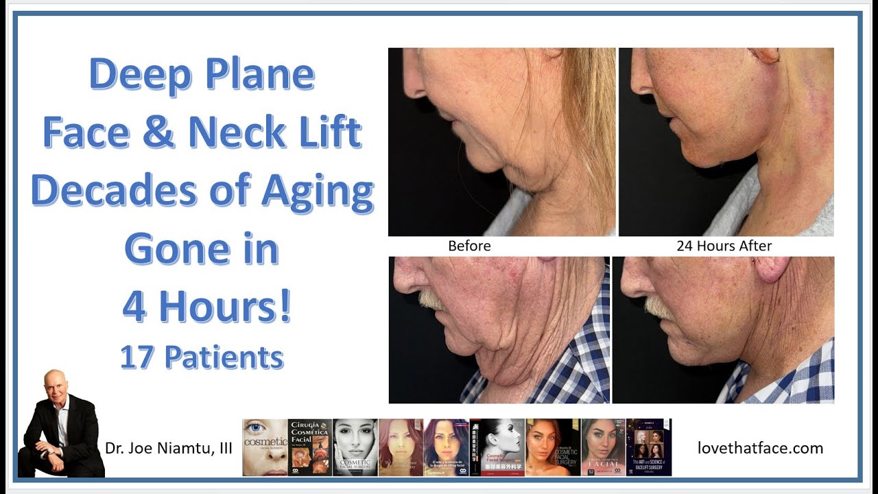 Deep Plane Face & Neck Lift: Decades of Aging Gone in 4 Hours