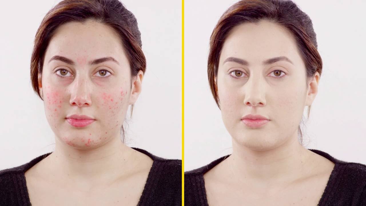 Come coprire l’acne - RiparCover Camouflage