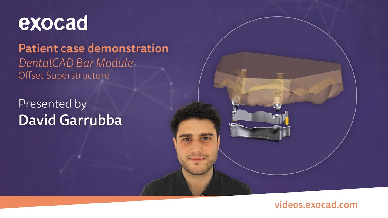 Patient Case Demonstration (5/6): DentalCAD Bar Module (Offest Superstructure)