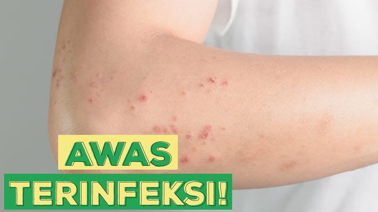 Waspada ! Penyakit Kulit Ini Bisa Saja Menyerang Kamu ! Begini Cara Mengatasinya