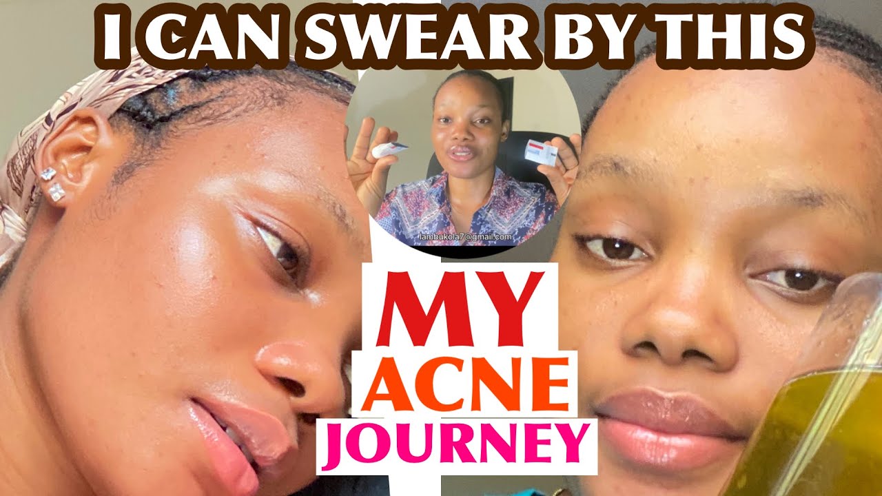 5 Chemical Exfoliant That Has Helped My Oily Skin/ Acne On My Skincare Journey