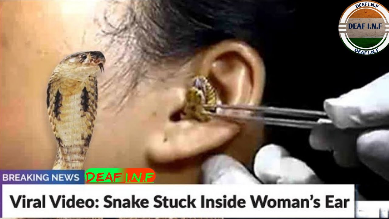 Viral Video: Snake Stuck Inside Women's Ear |DEAF I.N.F|@ISHNews|@MBMVadodara|@VOICEofDEAF#deaf