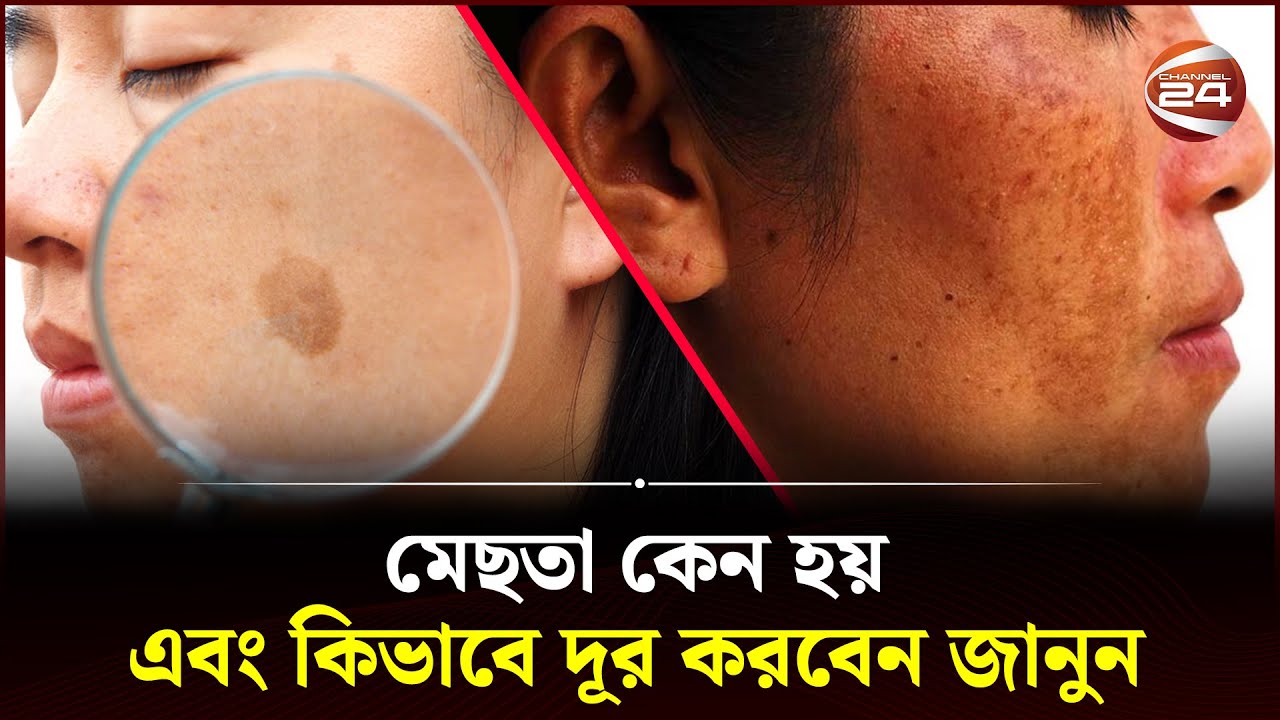 মেছতা কেন হয় এবং কিভাবে দূর করবেন জানুন | Health Tips | Skin Care | Channel 24
