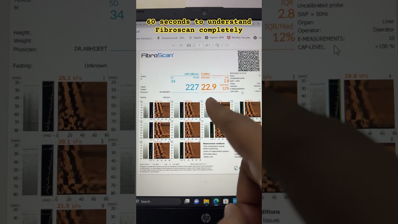 Easiest method (60 seconds) to understand Fibroscan report.