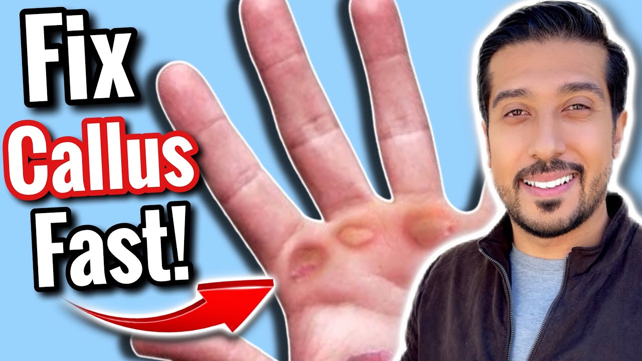 How to Get Rid of Calluses FAST in 5 EASY Steps