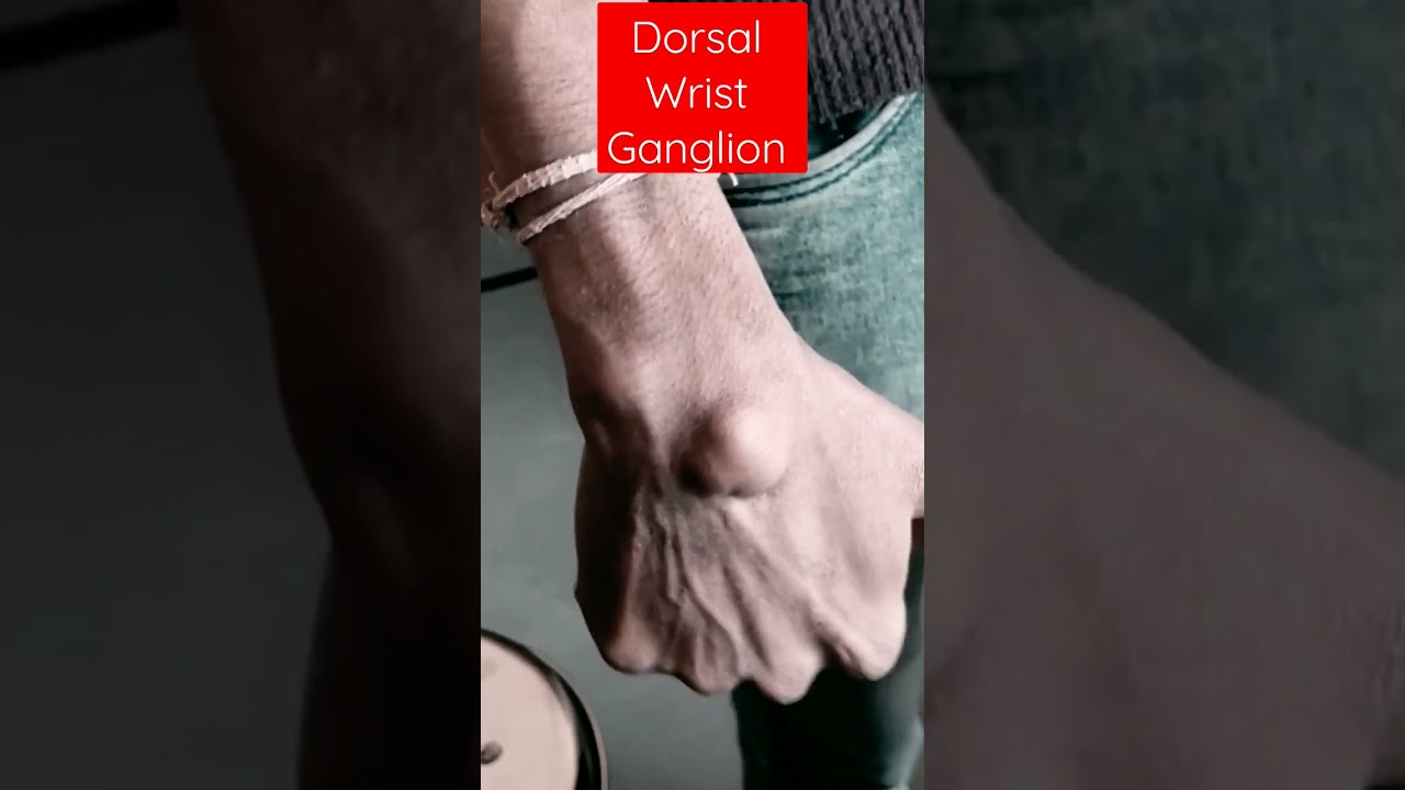 Dorsal wrist ganglion cyst #orthopedics #ganglion #neetpg