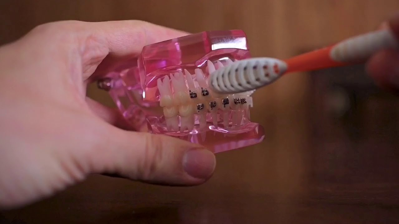 Why some people get gum disease when in braces